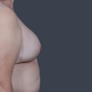 Implant Breast Reconstruction Before & After Gallery - Patient 134379 - Image 8