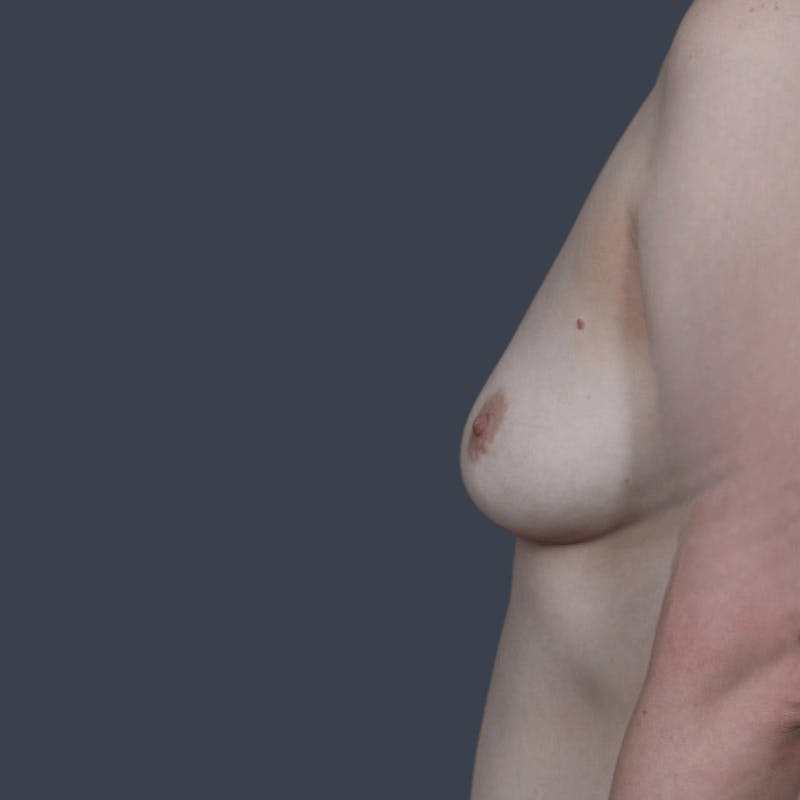 Nipple-Sparing Breast Reconstruction Before & After Gallery - Patient 182766 - Image 7