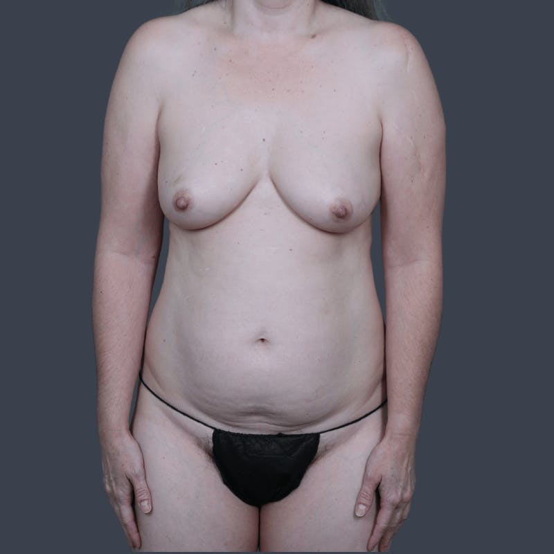DIEP Flap Before & After Gallery - Patient 749650 - Image 1