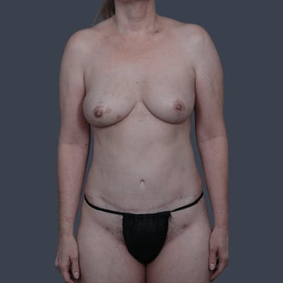 Nipple-Sparing Breast Reconstruction Before & After Gallery - Patient 781083 - Image 2