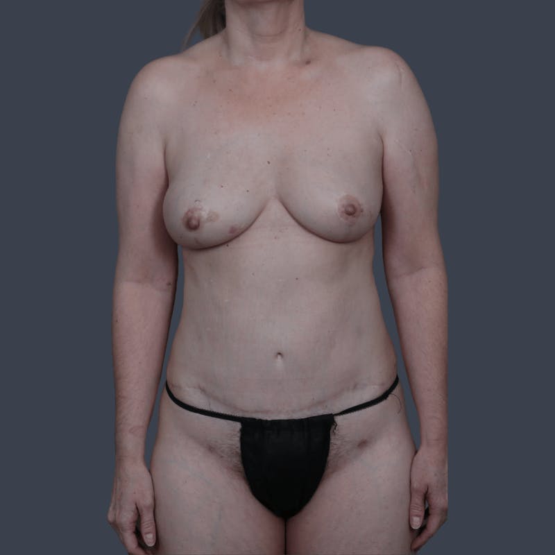 DIEP Flap Before & After Gallery - Patient 749650 - Image 2