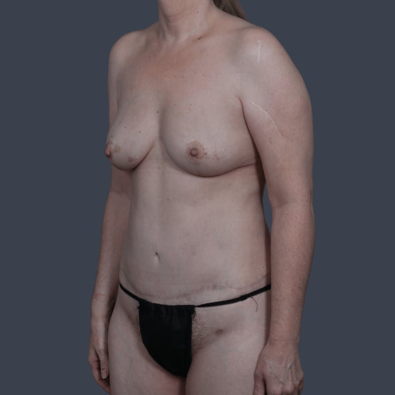 DIEP Flap Before & After Gallery - Patient 749650 - Image 6