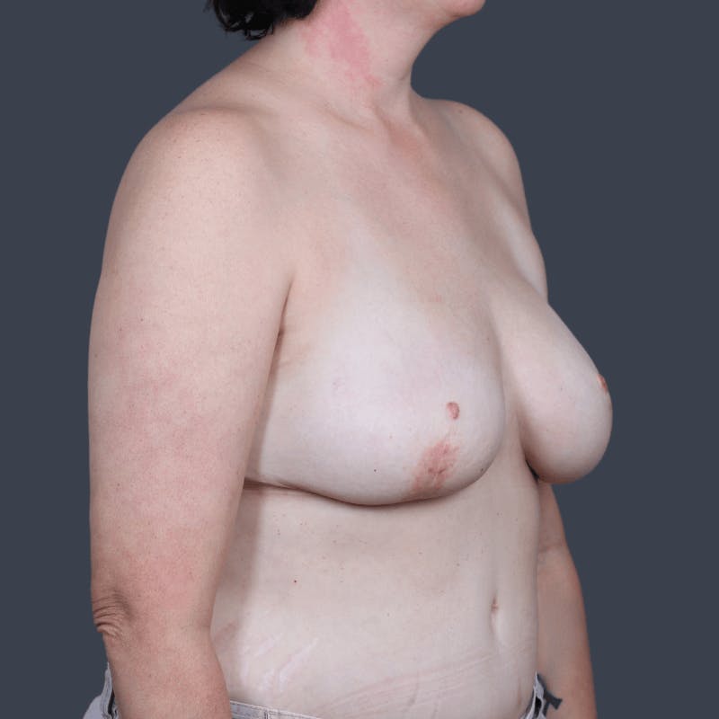 DIEP Flap Before & After Gallery - Patient 204991 - Image 4