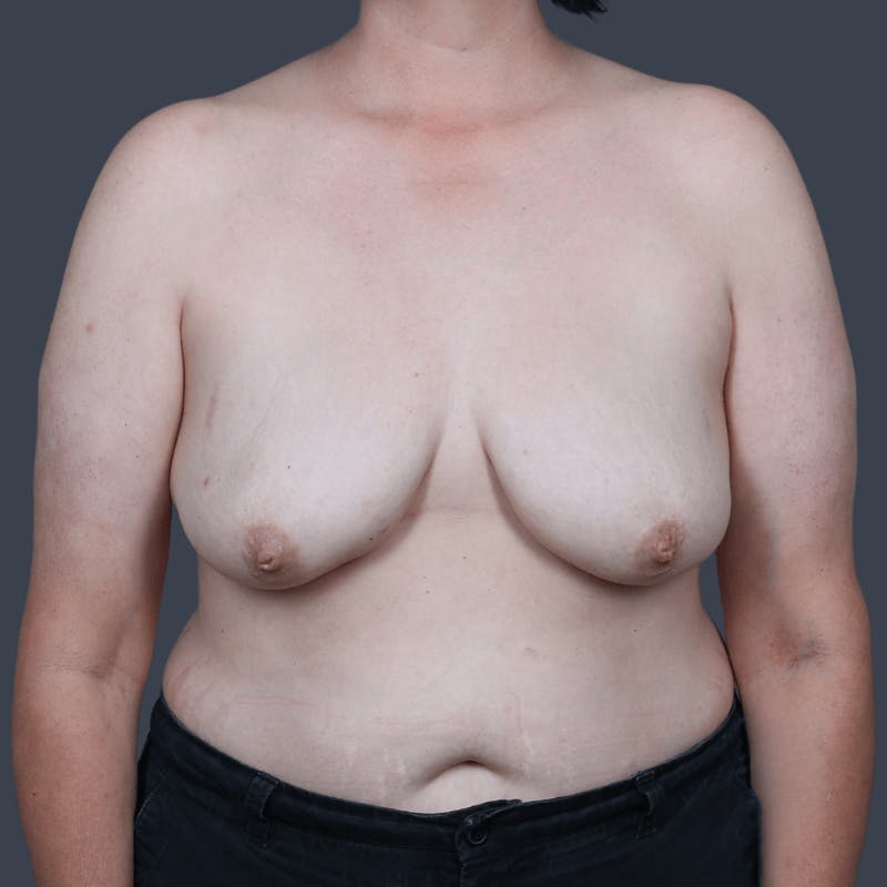 DIEP Flap Before & After Gallery - Patient 204991 - Image 1
