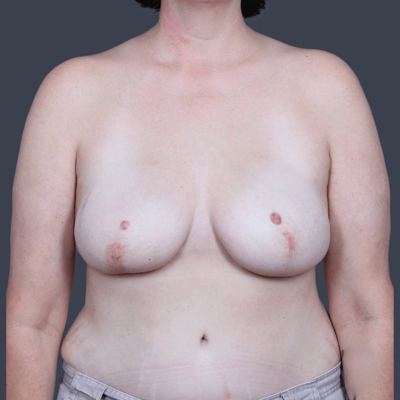 DIEP Flap Before & After Gallery - Patient 204991 - Image 2