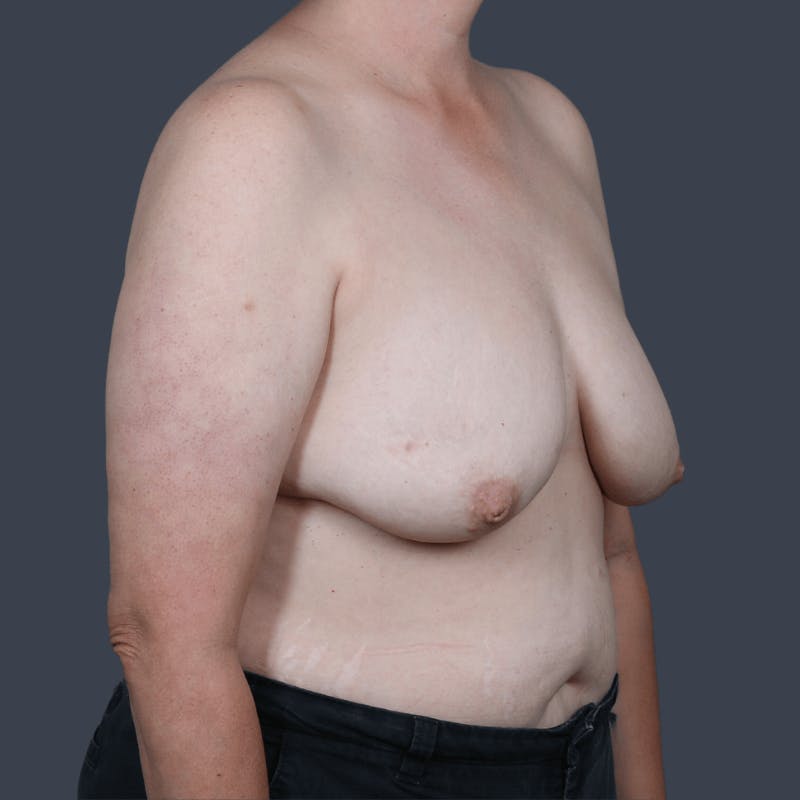 DIEP Flap Before & After Gallery - Patient 204991 - Image 3