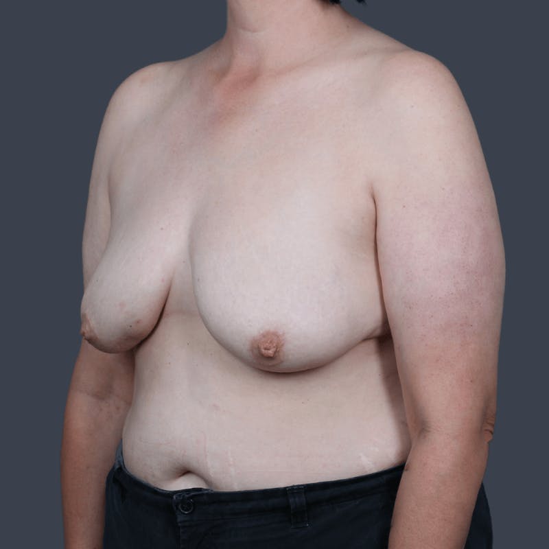 DIEP Flap Before & After Gallery - Patient 204991 - Image 5