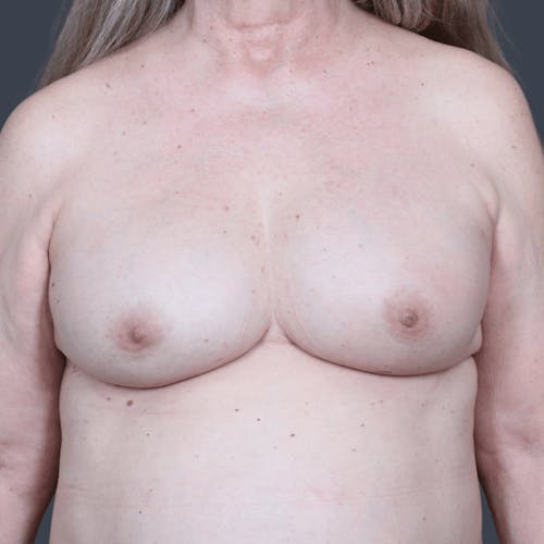 After procedure image for Breast Reconstruction