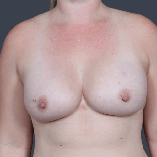 After procedure image for Breast Reconstruction