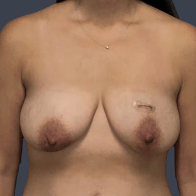Breast Reconstruction Before & After Gallery - Patient 284523 - Image 1