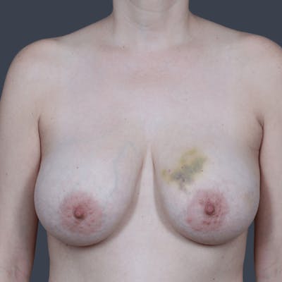 Oncoplastic Breast Reconstruction Before & After Gallery - Patient 102558 - Image 1