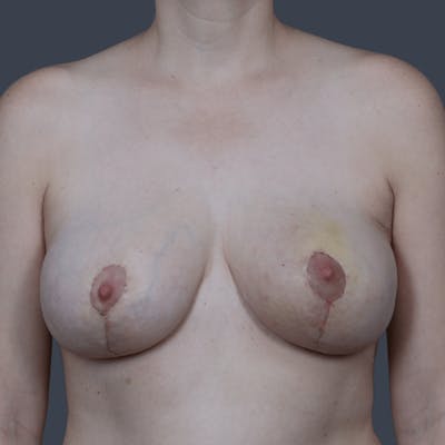 Oncoplastic Breast Reconstruction Before & After Gallery - Patient 102558 - Image 2