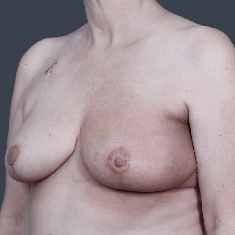 Breast Reconstruction Before & After Gallery - Patient 106538 - Image 6