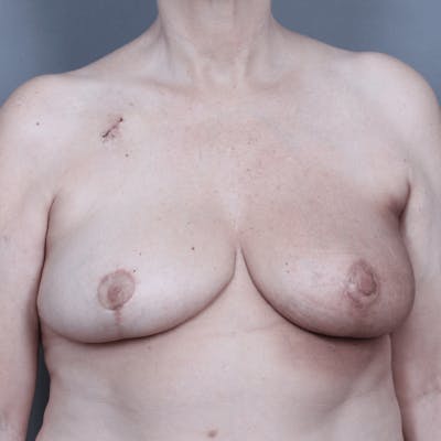 Breast Reconstruction Before & After Gallery - Patient 106538 - Image 2