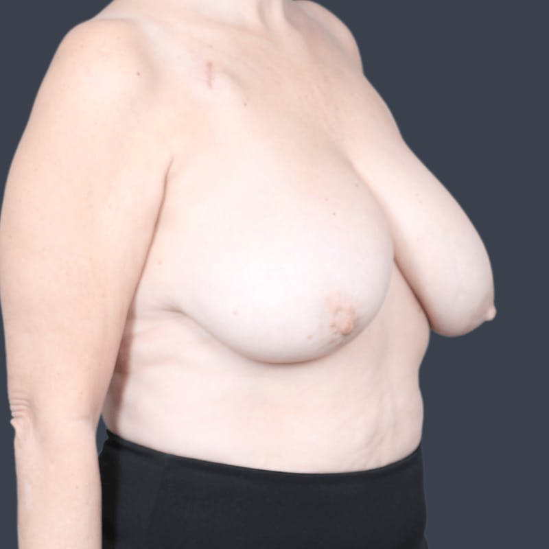 Breast Reconstruction Before & After Gallery - Patient 106538 - Image 3
