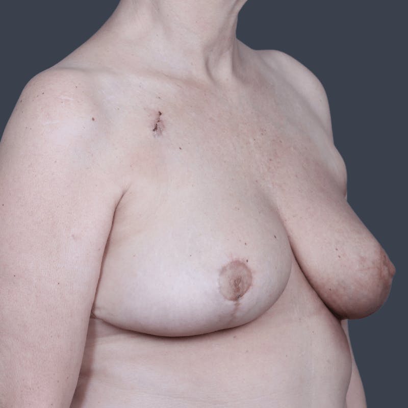 Breast Reconstruction Before & After Gallery - Patient 106538 - Image 4