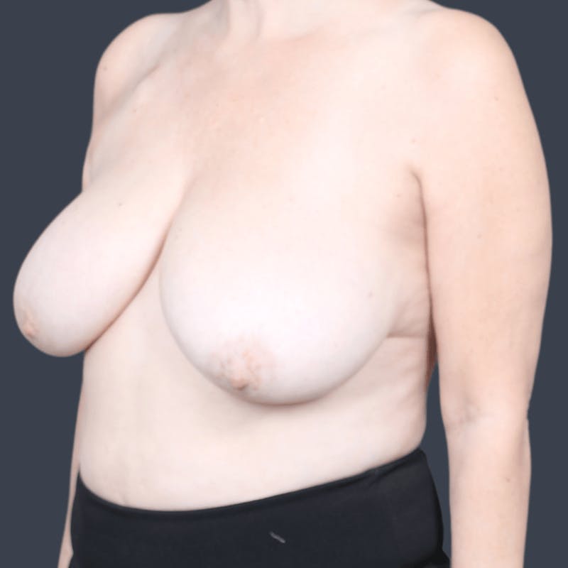 Breast Reconstruction Before & After Gallery - Patient 106538 - Image 5