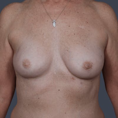 Oncoplastic Breast Reconstruction Before & After Gallery - Patient 209949 - Image 1