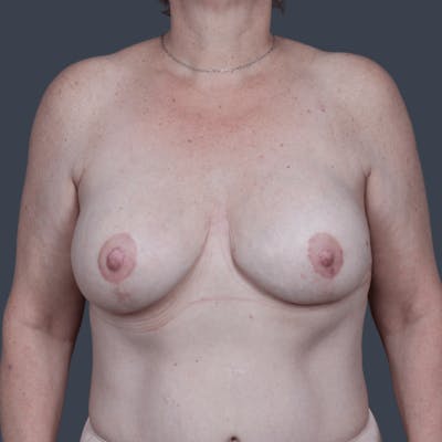 Nipple-Sparing Breast Reconstruction Before & After Gallery - Patient 282740 - Image 2