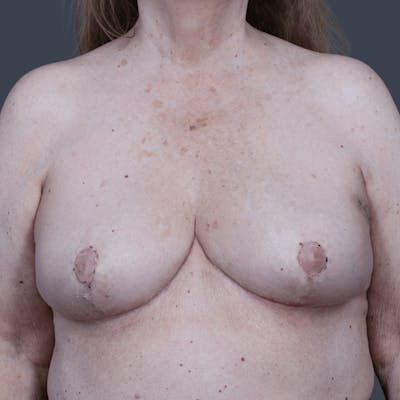 Breast Reduction Before & After Gallery - Patient 370431 - Image 2