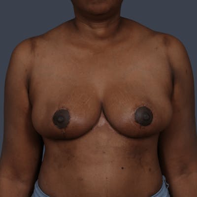 Breast Asymmetry / Tuberous Breasts Before & After Gallery - Patient 311872 - Image 2
