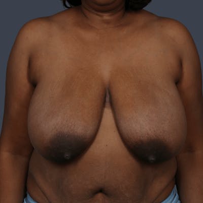 Breast Asymmetry / Tuberous Breasts Before & After Gallery - Patient 311872 - Image 1