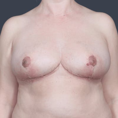 Breast Asymmetry / Tuberous Breasts Before & After Gallery - Patient 250862 - Image 2
