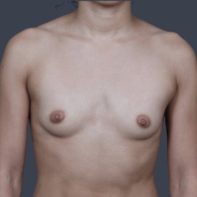 Breast Augmentation Before & After Gallery - Patient 372677 - Image 1