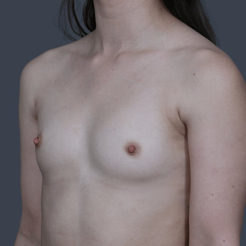 Breast Augmentation Before & After Gallery - Patient 357658 - Image 5