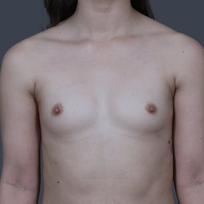 Breast Augmentation Before & After Gallery - Patient 357658 - Image 1