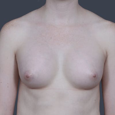 Breast Augmentation Before & After Gallery - Patient 166819 - Image 2