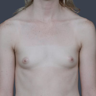 Breast Augmentation Before & After Gallery - Patient 166819 - Image 1