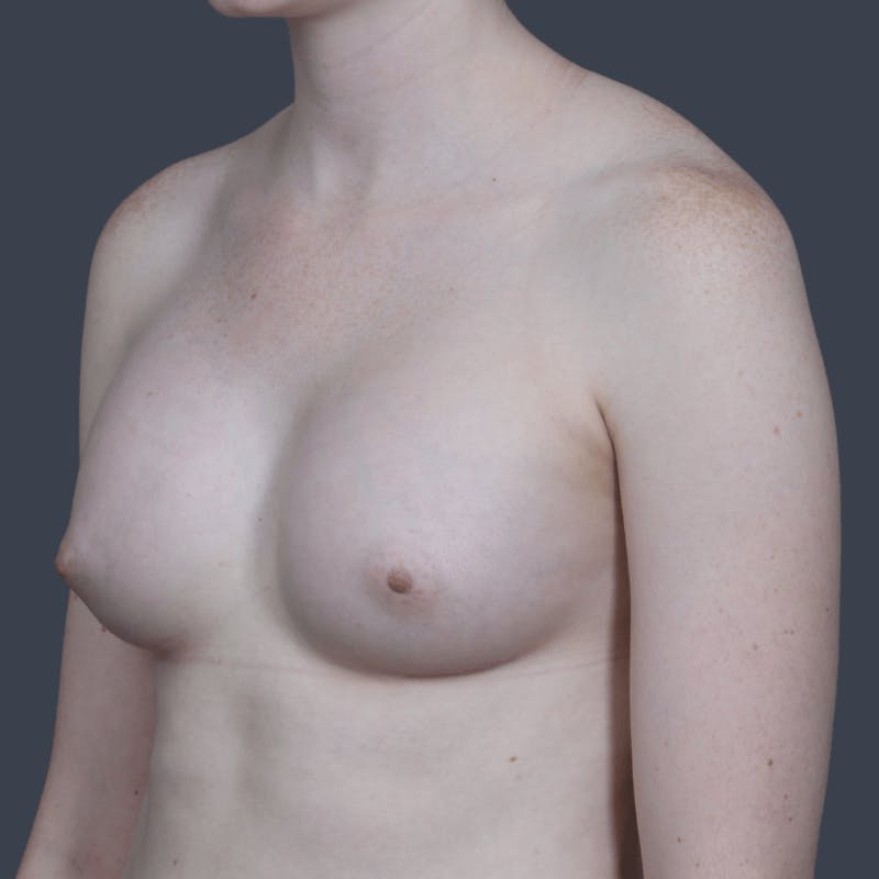 Breast Augmentation Before & After Gallery - Patient 166819 - Image 6