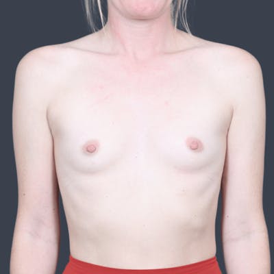 Breast Augmentation Before & After Gallery - Patient 226504 - Image 1