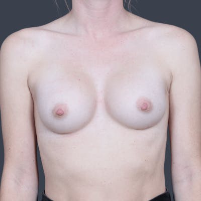 Breast Augmentation Before & After Gallery - Patient 226504 - Image 2
