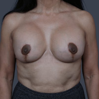 Breast Augmentation Before & After Gallery - Patient 204369 - Image 2