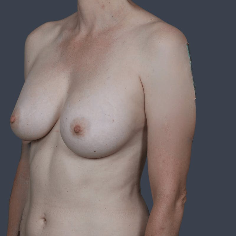 Implant Removal Before & After Gallery - Patient 423714 - Image 5