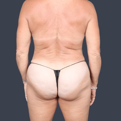 Liposuction Before & After Gallery - Patient 353846 - Image 2