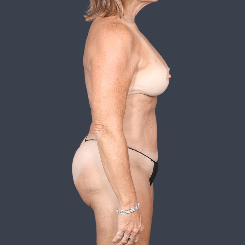 Liposuction Before & After Gallery - Patient 353846 - Image 6