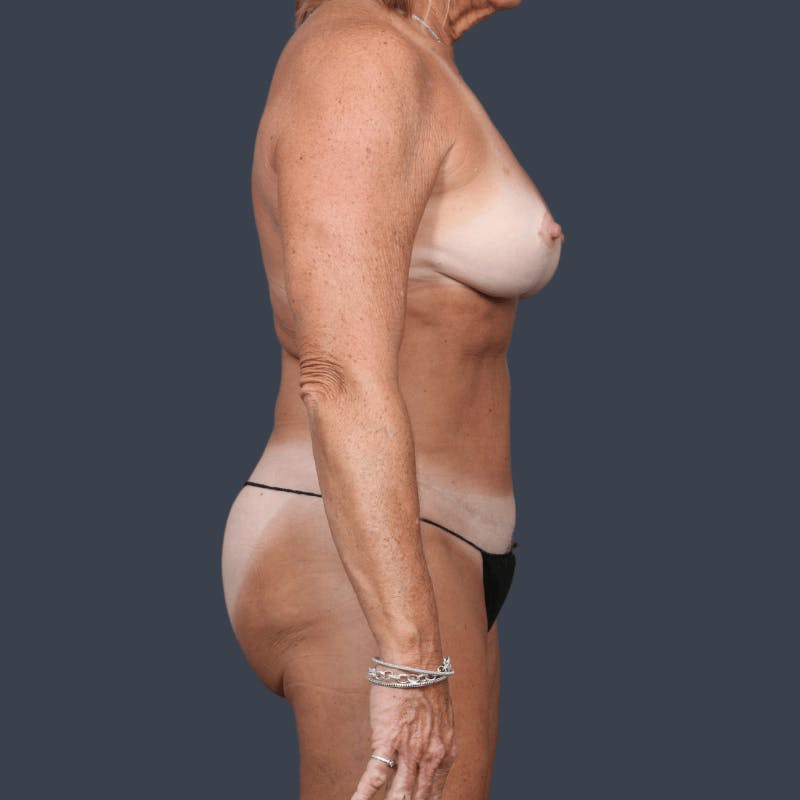 Liposuction Before & After Gallery - Patient 353846 - Image 5