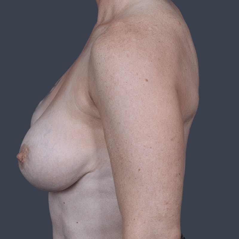 Implant Removal Before & After Gallery - Patient 236679 - Image 5