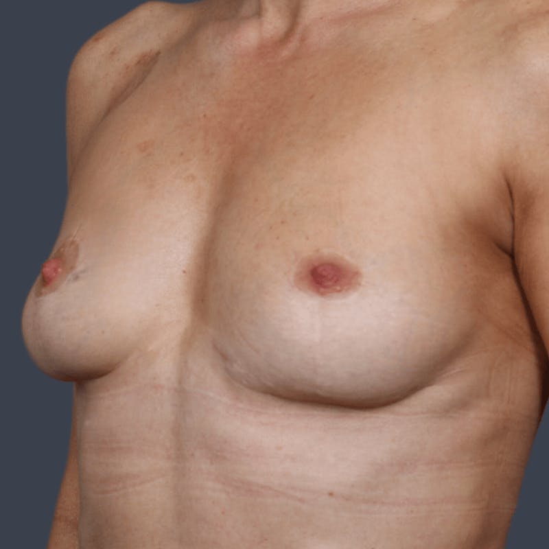 Implant Removal Before & After Gallery - Patient 236679 - Image 4