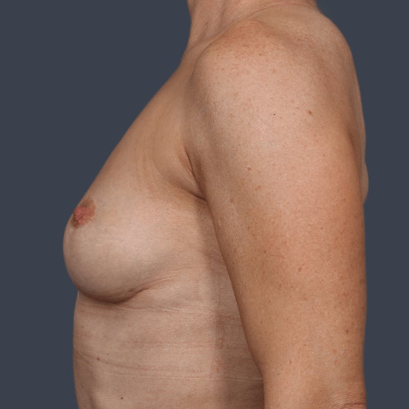 Implant Removal Before & After Gallery - Patient 236679 - Image 6