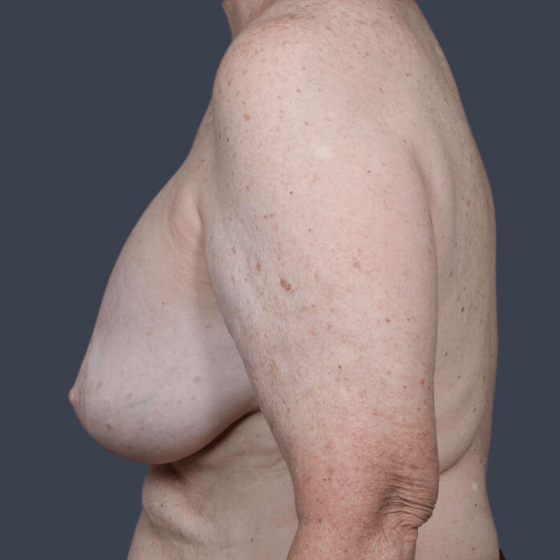 Implant Removal Before & After Gallery - Patient 387075 - Image 5