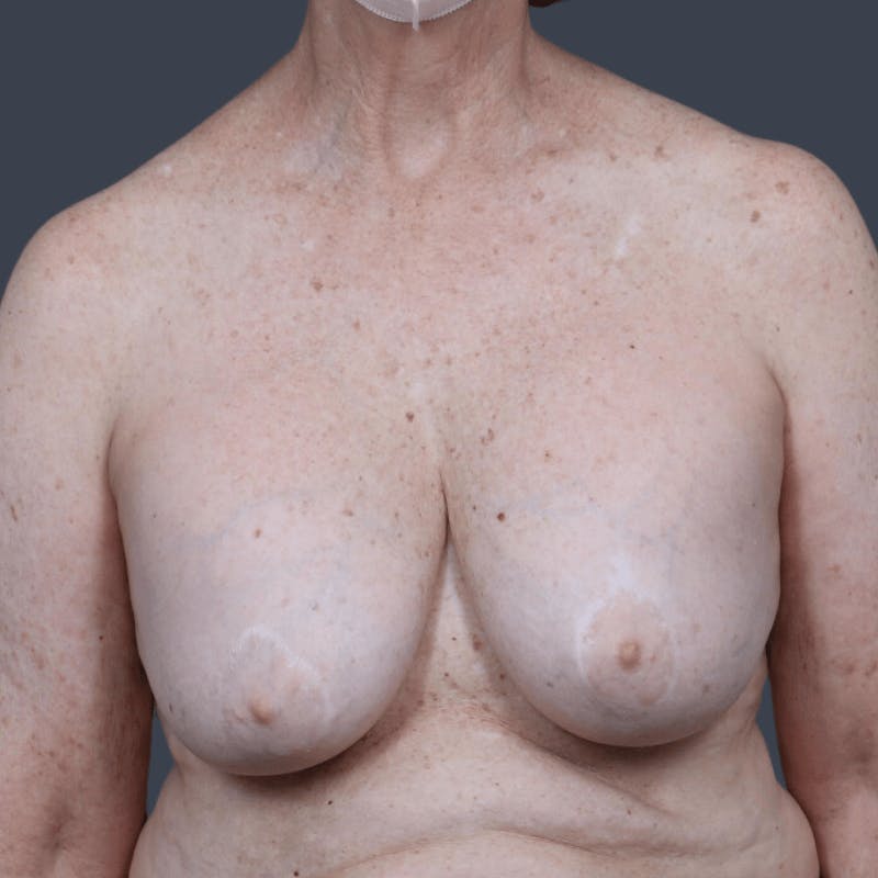 Implant Removal Before & After Gallery - Patient 387075 - Image 1