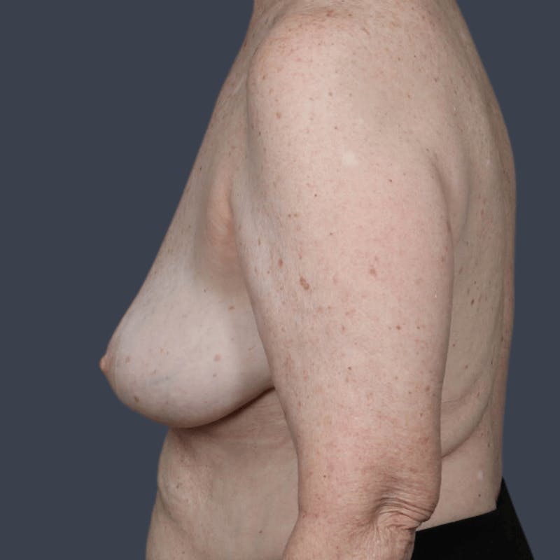 Implant Removal Before & After Gallery - Patient 387075 - Image 6