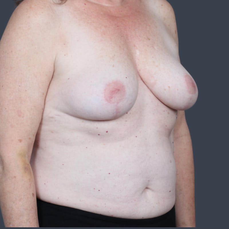 Implant Removal Before & After Gallery - Patient 108651 - Image 4