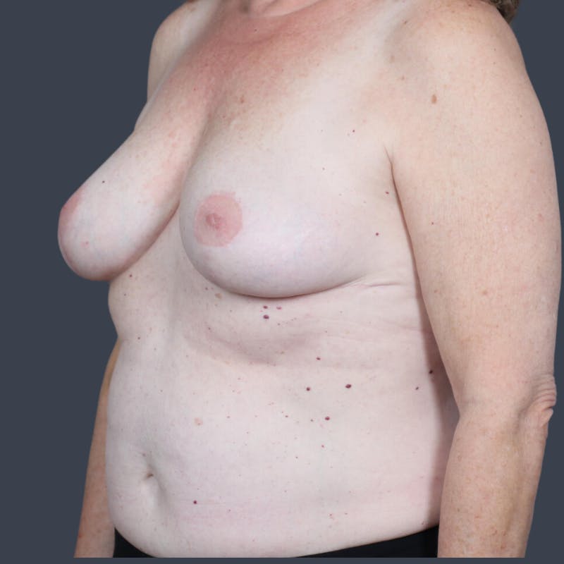 Implant Removal Before & After Gallery - Patient 108651 - Image 6