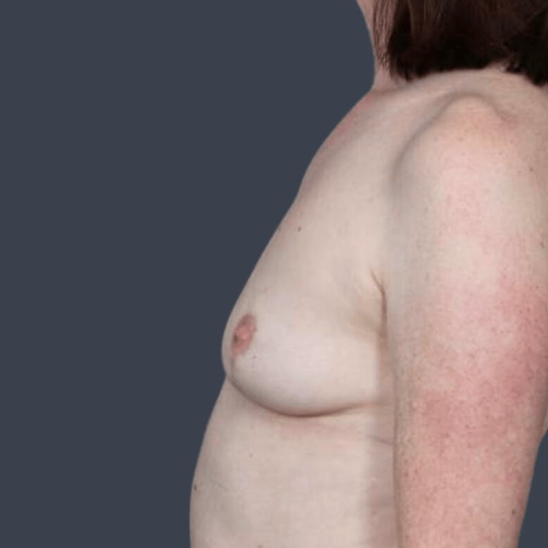 Implant Removal Before & After Gallery - Patient 408090 - Image 6