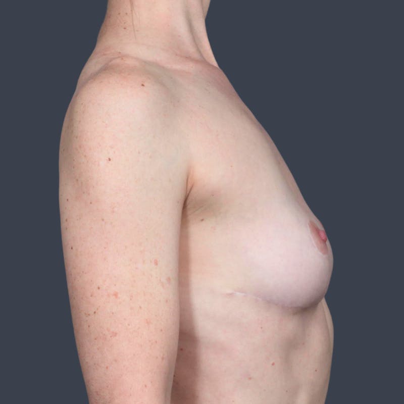 Implant Removal Before & After Gallery - Patient 341866 - Image 6